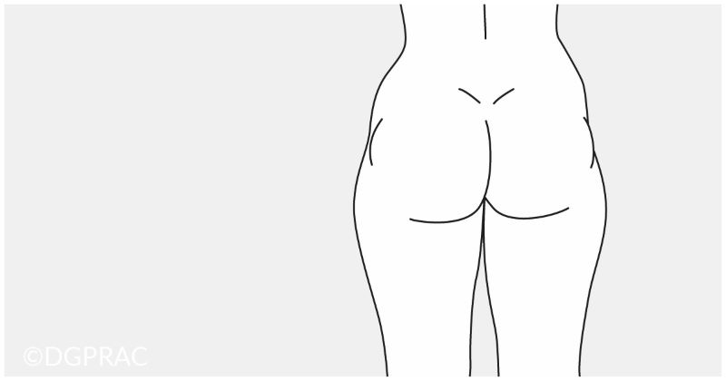 Medical illustration: starting point with fat deposits on the hips and outer thighs