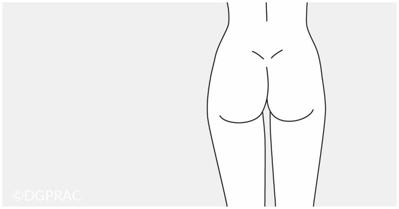 Medical illustration: harmonious body contour after liposuction
