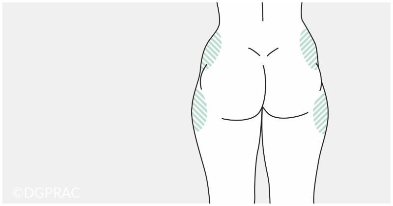 Medical illustration: treatment areas marked on the hips and outer thighs