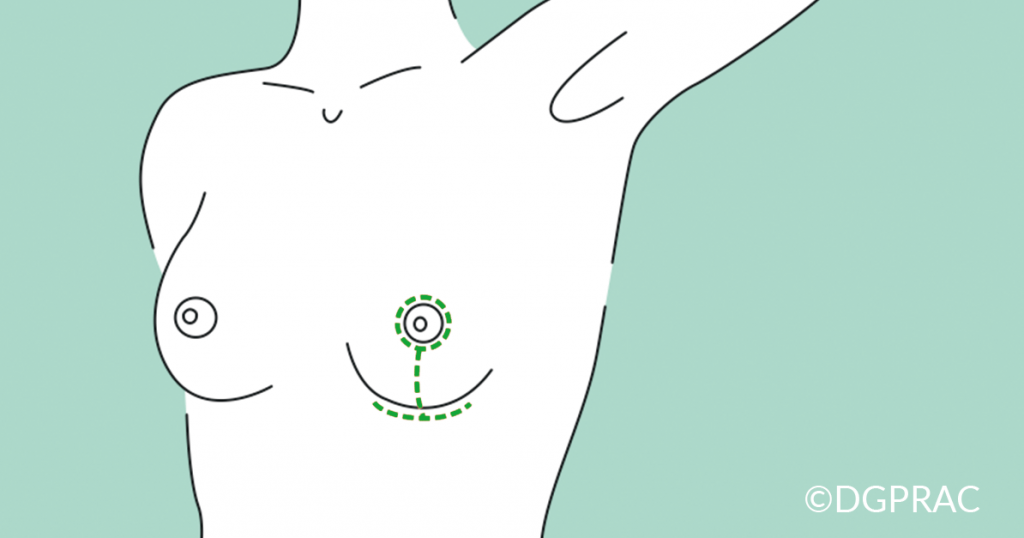Ilustración médica de la DGPRÄC: cicatriz en forma de T a ambos lados del surco submamario