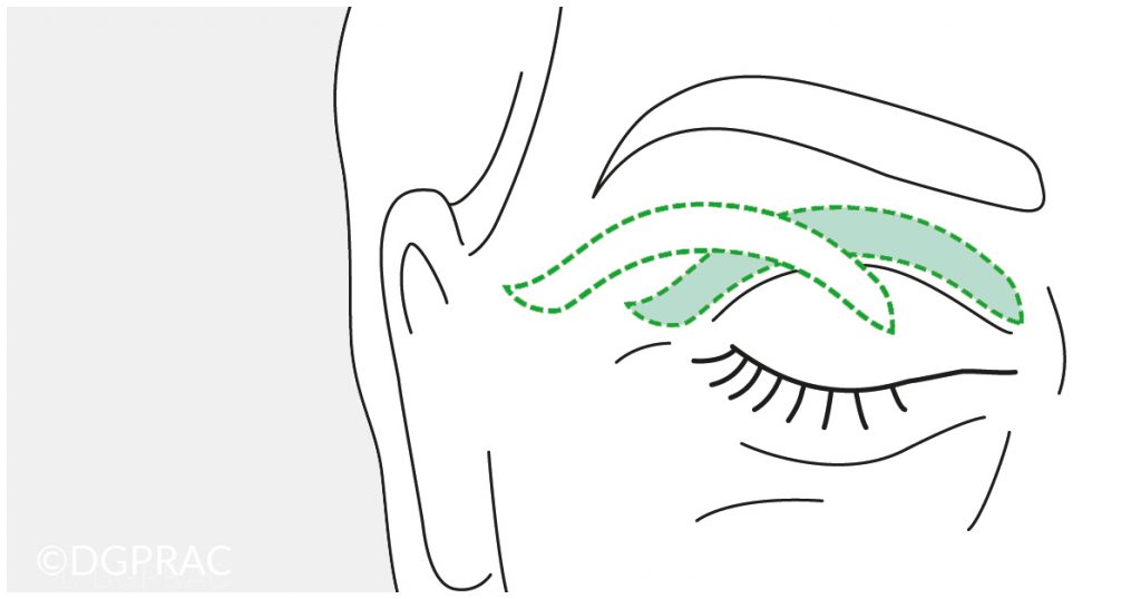 Medical illustration: starting point with excess skin on the upper lid