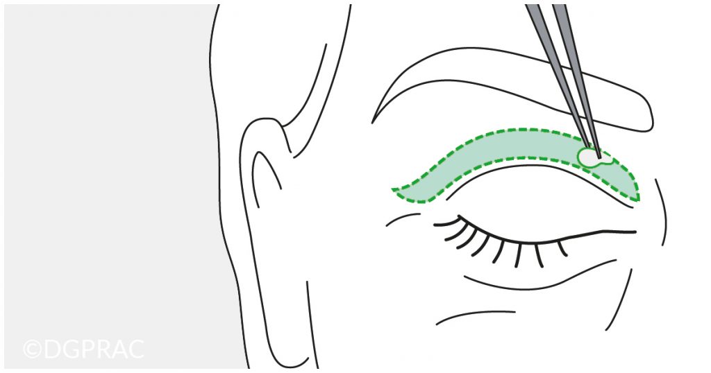 Medical illustration: incision on the upper lid
