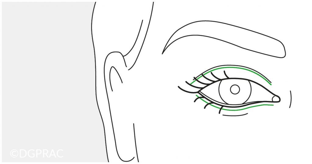 Medical illustration: the nasal fat pad of the upper lid