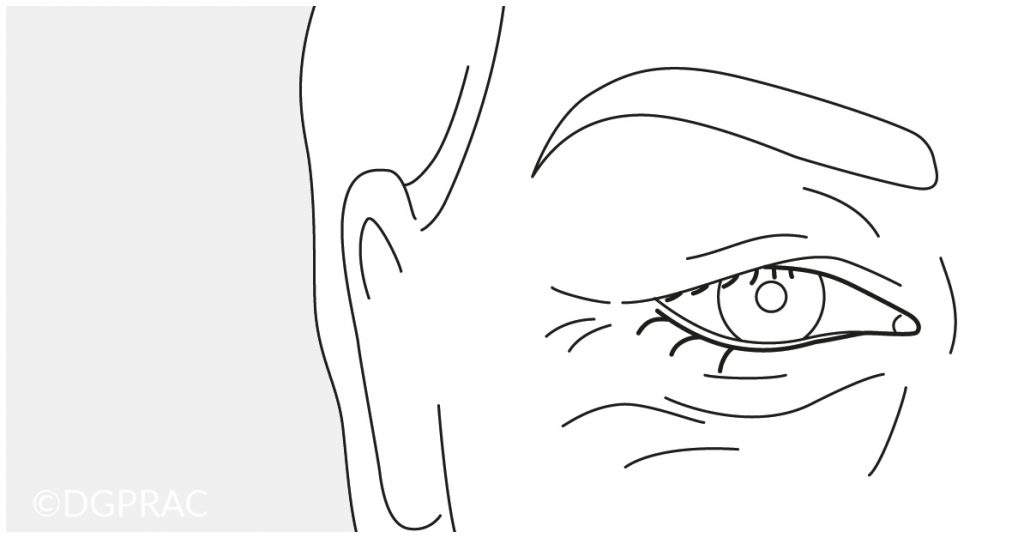 Medical illustration: incision on the lower lid