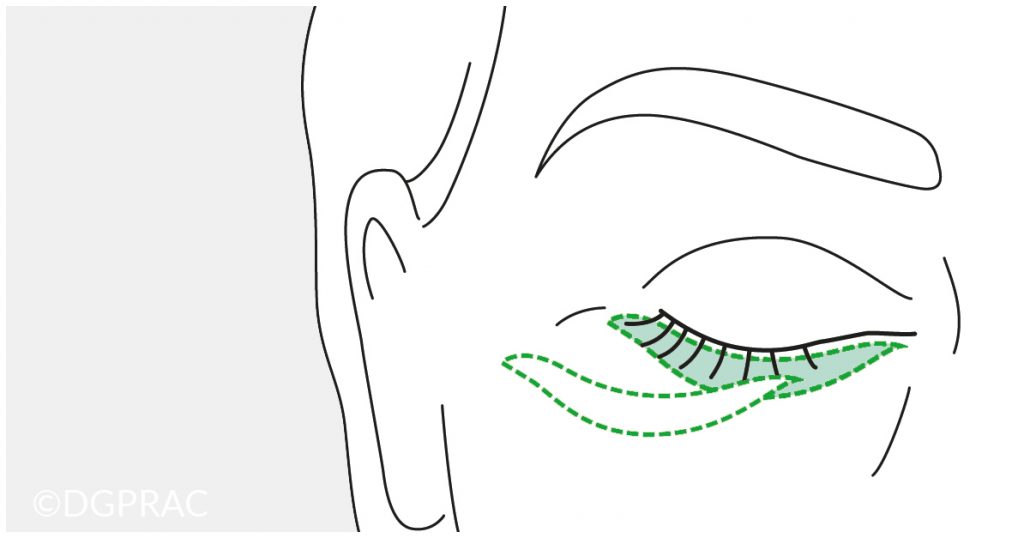 Medical illustration: scar course after eyelid surgery