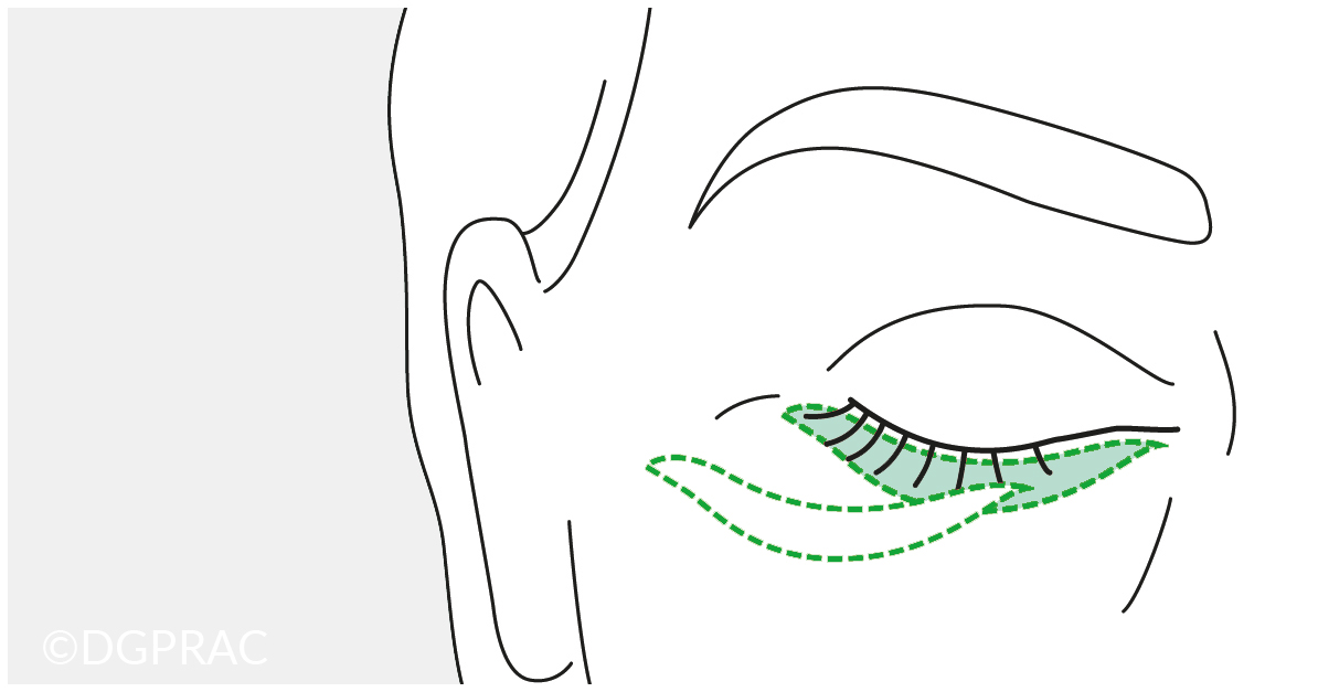 Augenlidkorrekturen und Augenlidstraffung in der Praxis FINKE & FRANTZEN Plastische Chirurgie Berlin
