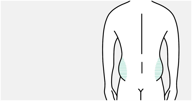 Medical illustration: the treatment areas marked on the flanks