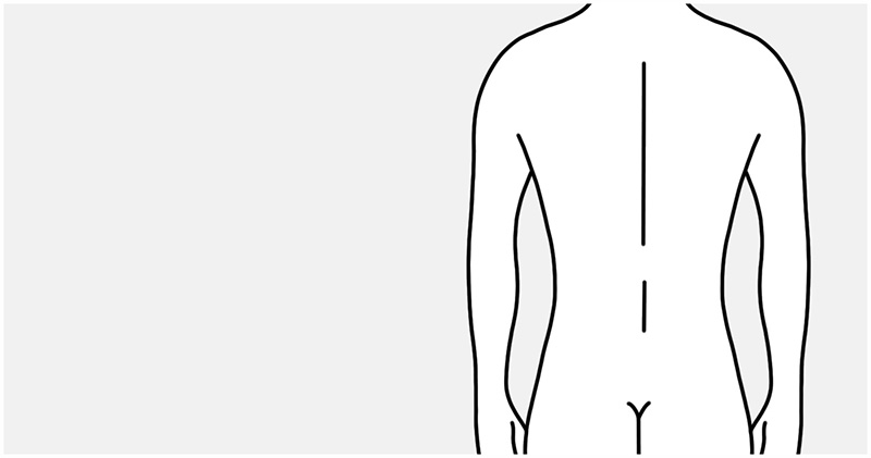 Medical illustration: the contour after liposuction of the flanks