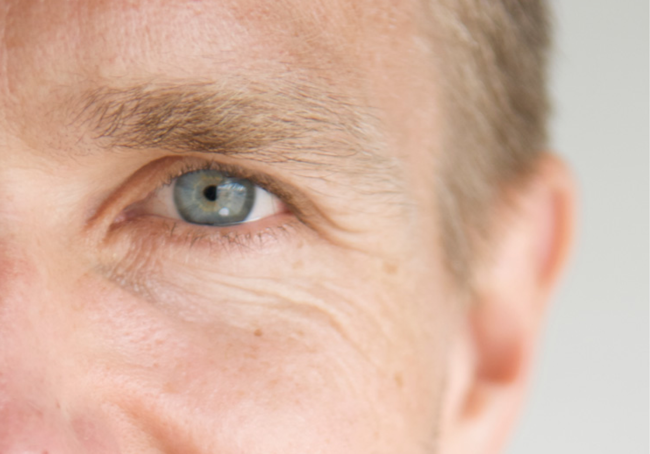 Eyelid surgery for men in Berlin – upper and lower lid tightening