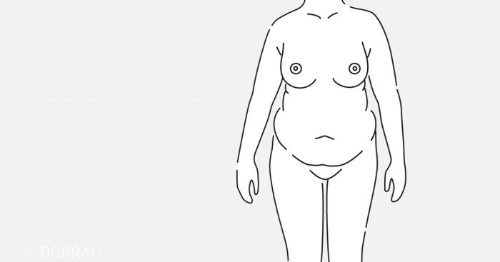 Medical illustration: starting point with an overstretched abdominal wall