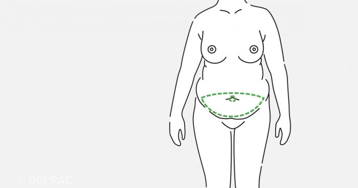 Medical illustration: planning the scar in the lower abdominal crease