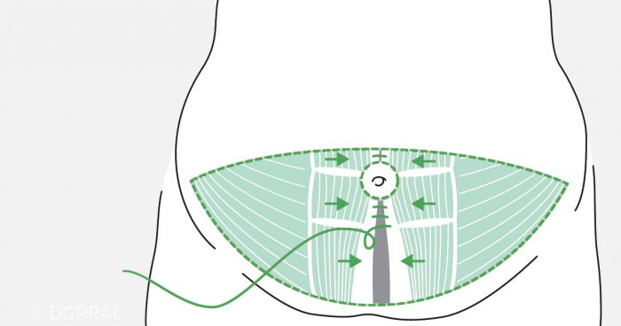 Medical illustration: tightening the separated abdominal muscles