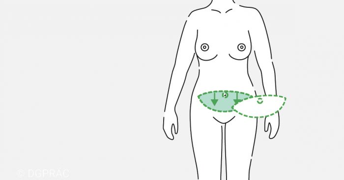 Medical illustration: the abdominal wall is drawn downwards