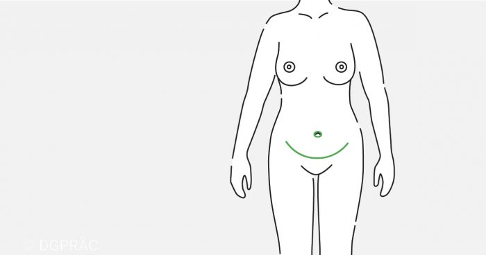 Medical illustration: result after a classic tummy tuck