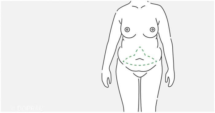 Medical illustration: extended tummy tuck with vertical marking