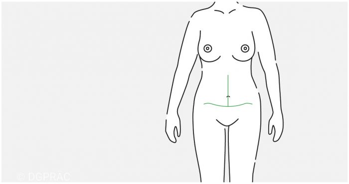 Medical illustration: result after an extended tummy tuck
