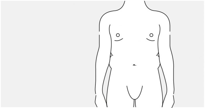 Medizinische Illustration: Ausgangsbefund – Bauchdecke des Mannes vor der Straffung