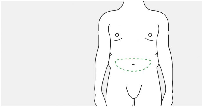 Medical illustration: planning the scar in the lower abdominal crease (male abdomen)
