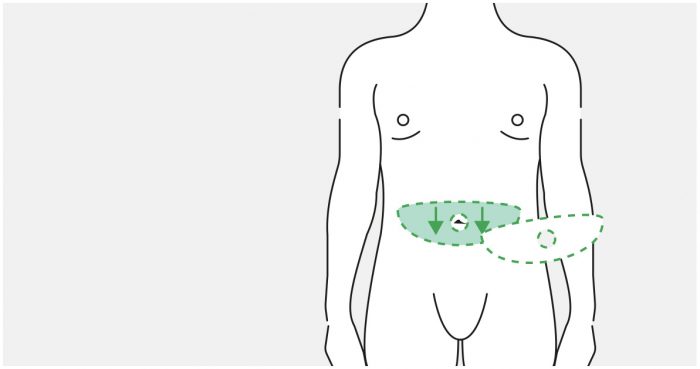 Medical illustration: the abdominal wall is drawn downwards (male abdomen)