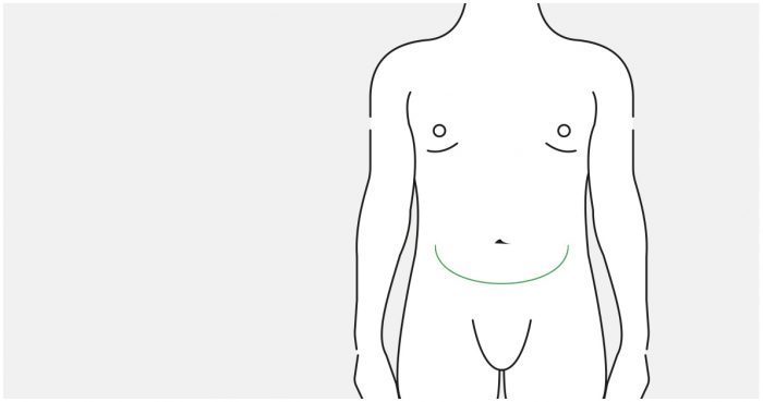Medical illustration: result after a classic tummy tuck (male abdomen)