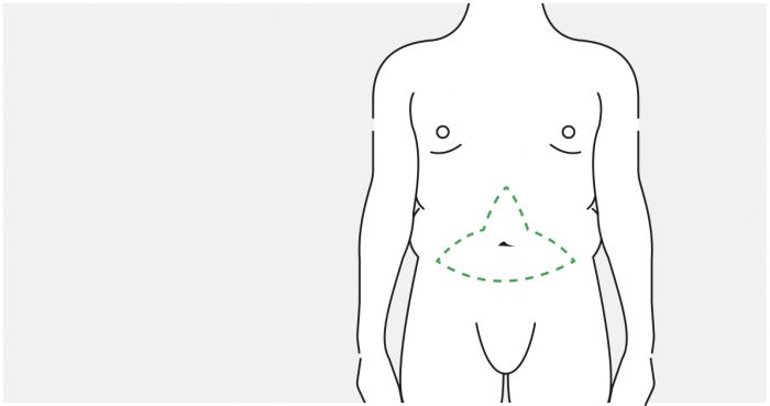 Medical illustration: extended tummy tuck with vertical marking (male abdomen)