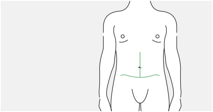 Medical illustration: result after an extended tummy tuck (male abdomen)
