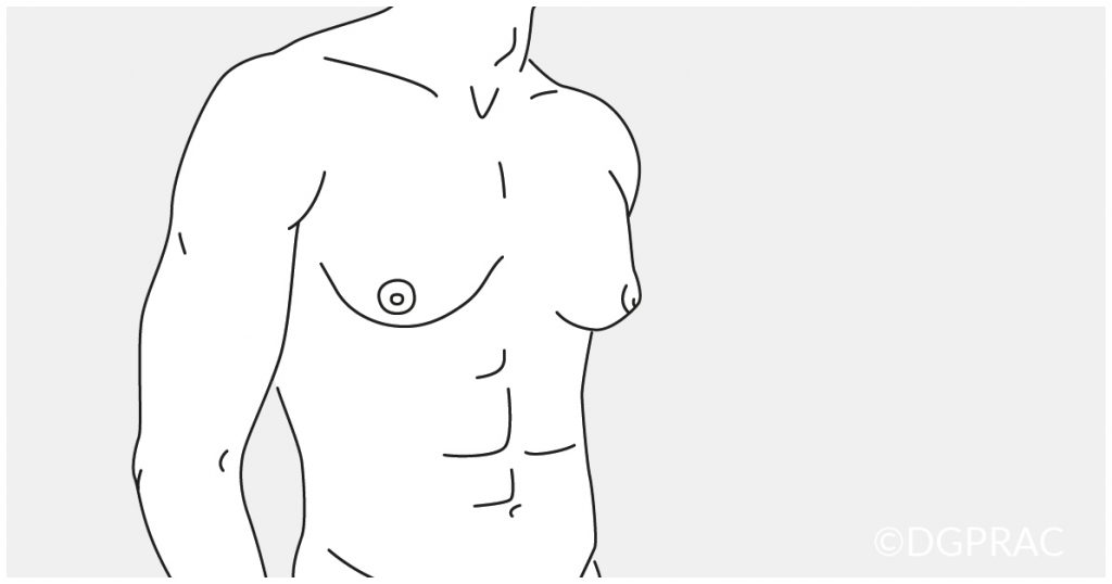 Medical illustration: male torso with pronounced glandular tissue