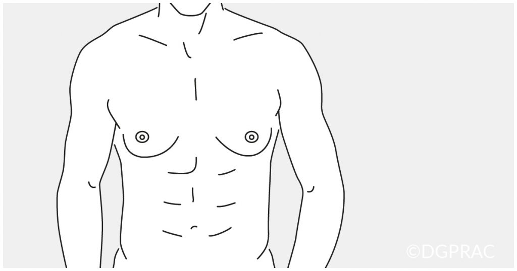 Medical illustration: male torso with enlarged breasts, predominantly fatty tissue