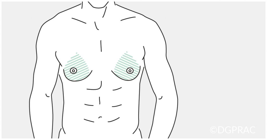 Medical illustration: marked liposuction areas on the male chest