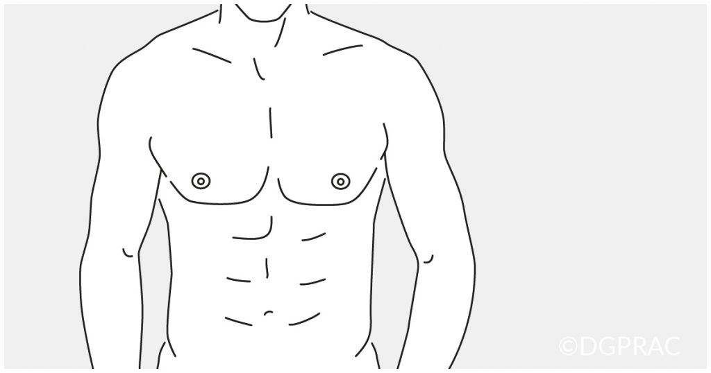 Medical illustration: flat, defined male chest after liposuction