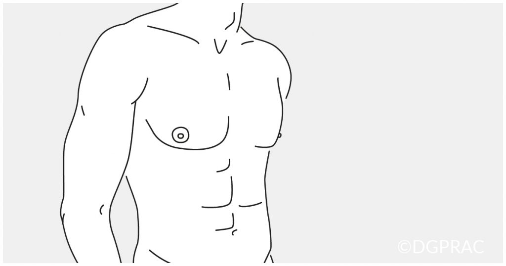 Medical illustration: flat male chest after subcutaneous mastectomy