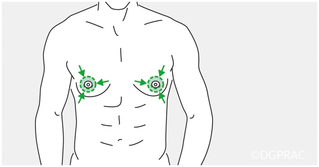 Medical illustration: incision around the areola for gland removal